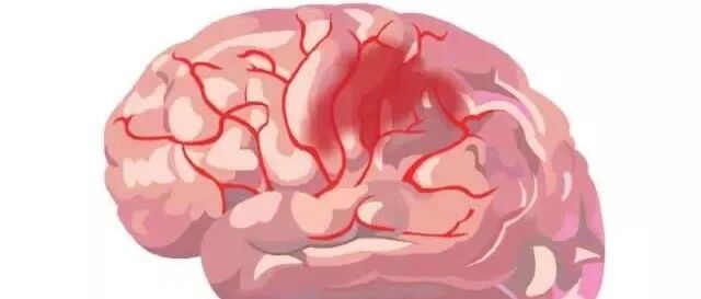 太形象！脑卒中3分钟漫画