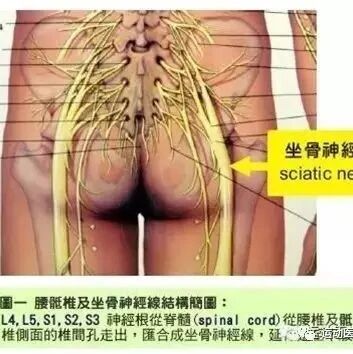坐骨神经痛如何康复？