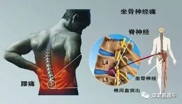 腰間盤突出康復鍛煉「10字經」，簡單有效！ 健康 第2張