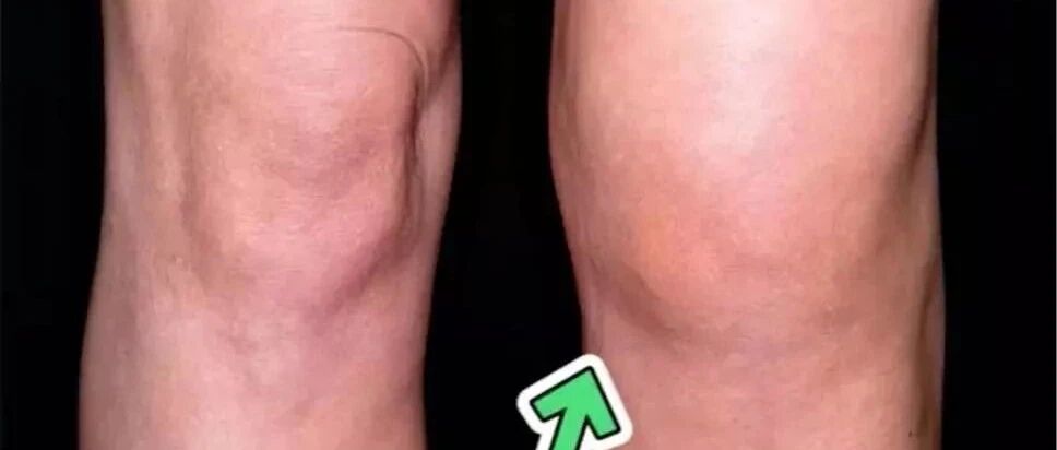 膝盖退化的这三种征兆，用肉眼就能看出！