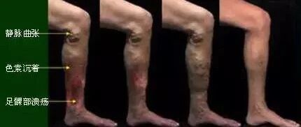 下肢静脉曲张的康复治疗（图文解读）