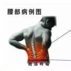 【干货】深入细说坐骨神经痛