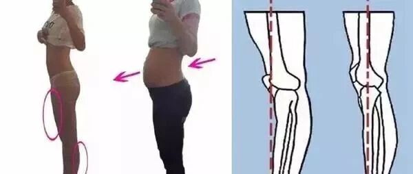 骨盆前倾如何诊断以及康复训练方法