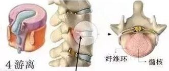最常规的腰椎间盘医学康复锻炼