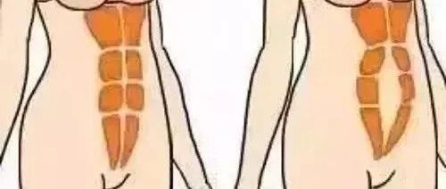 产后康复核心——腹直肌分离