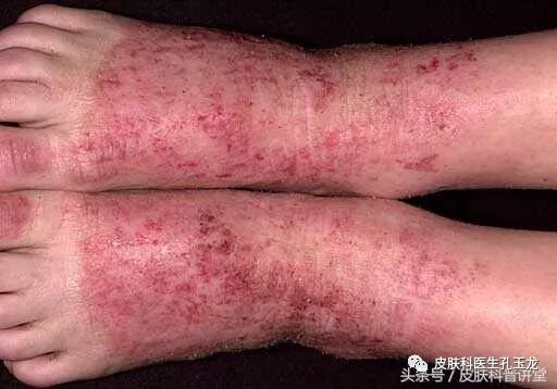 反复过敏，到底要不要查过敏原？过敏原检测的意义有多大？