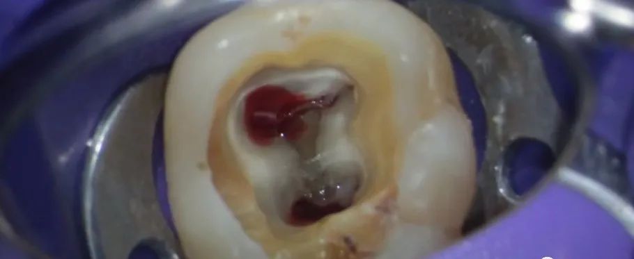 逐步后退法、冠向下法、步进法的一些常见操作解析