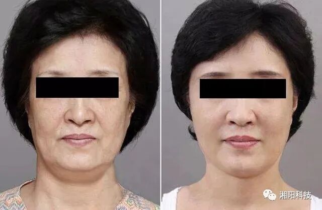 多极射频是什么射频美容原理及特点_https://www.jmylbn.com_新闻资讯_第7张