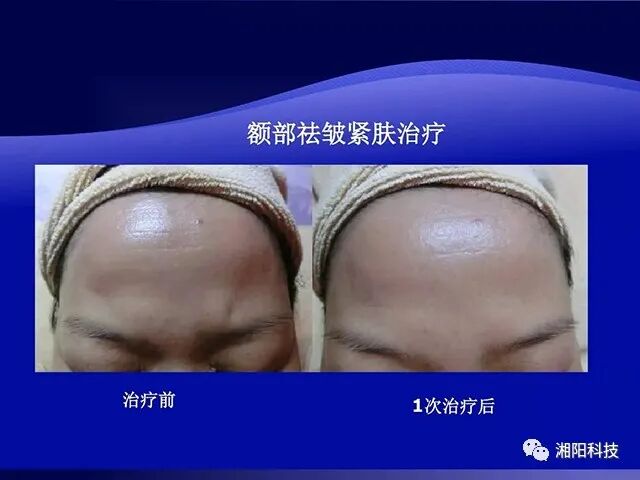 多极射频是什么射频美容原理及特点_https://www.jmylbn.com_新闻资讯_第6张