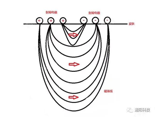 多极射频是什么射频美容原理及特点_https://www.jmylbn.com_新闻资讯_第5张