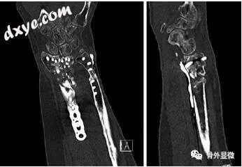 手腕和手的不愈合 骨外显微 微信公众号文章阅读 Wemp