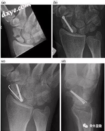手腕和手的不愈合 骨外显微 微信公众号文章阅读 Wemp