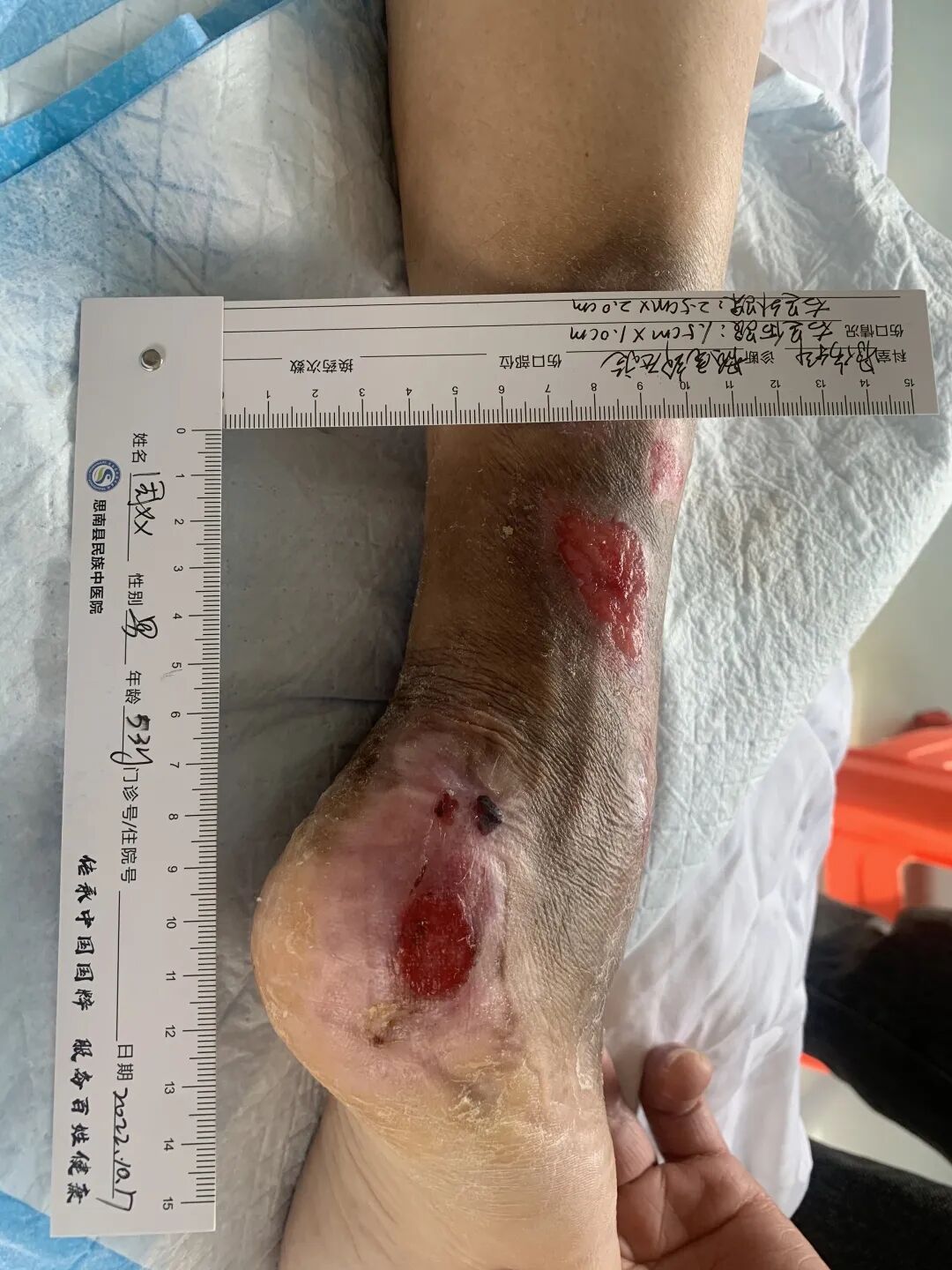 伤口负压治疗怎么收费慢创伤口患者的福音｜ 县民族中医院负压治疗技术运用成熟_https://www.jmylbn.com_新闻资讯_第9张