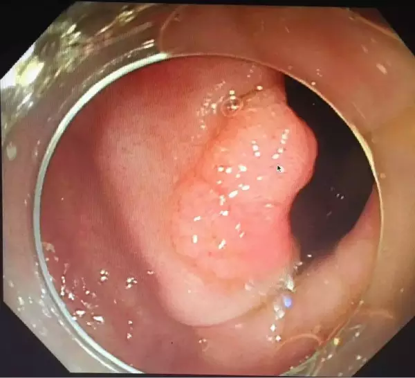 结肠良性肿瘤内镜下微创切除