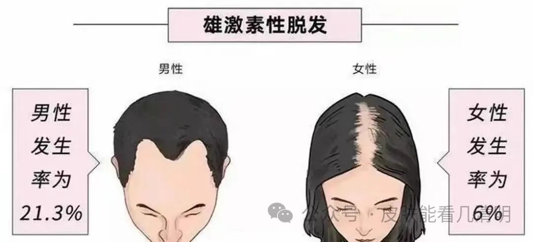 脂溢性脱发，还有救吗？