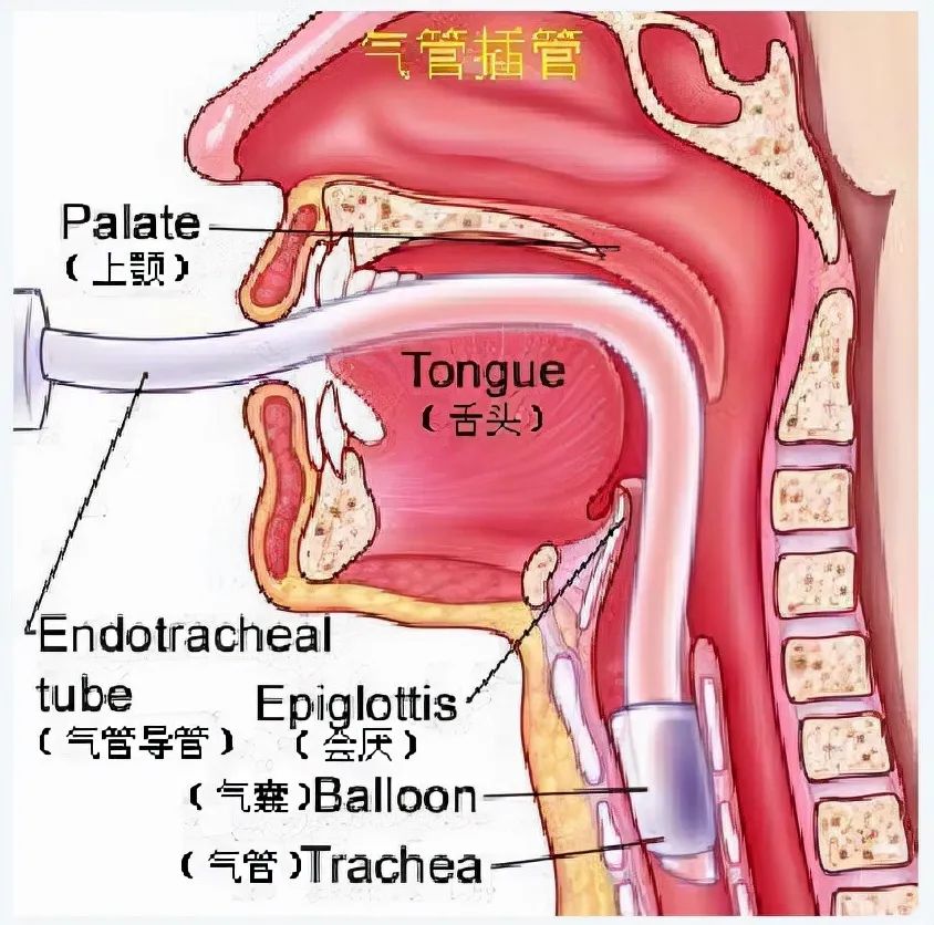 术后咽喉痛(postoperative sore throat,post)常见于行全麻气管插管