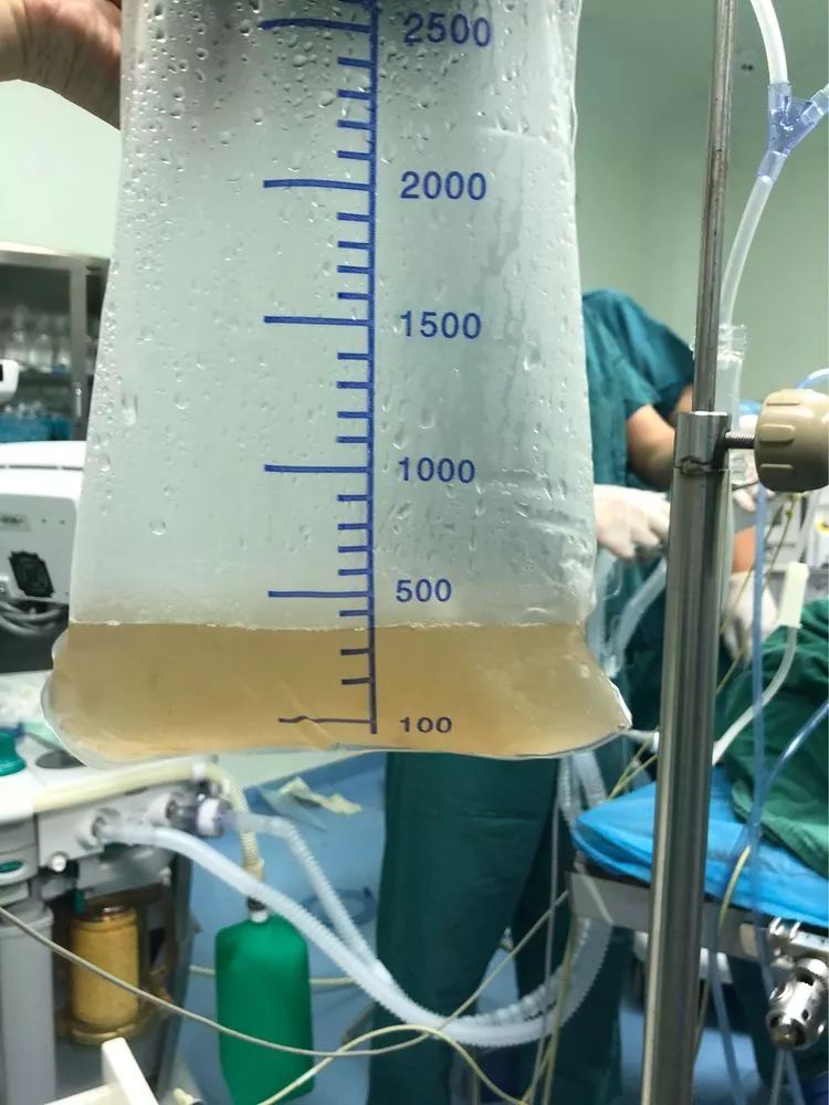 直击尘肺患者洗肺手术现场，除了洗肺还有更好的治疗方案吗？