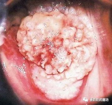女性肿瘤死亡率第一的宫颈癌