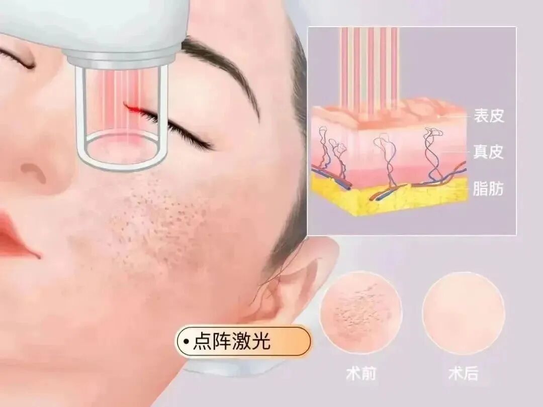 点阵激光后冷敷怎么敷【健康科普】点阵激光术后的日常护理_https://www.jmylbn.com_新闻资讯_第2张