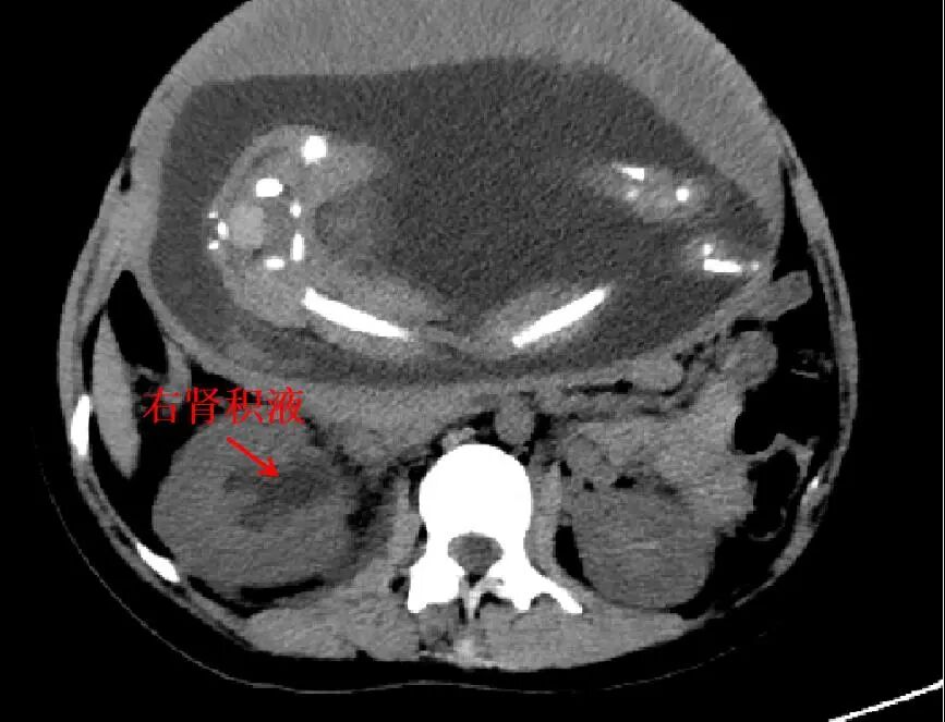 猪输尿管怎么吃【典型案例】怀孕7月腹痛不止，医生巧用“猪尾巴管”安全解决！_https://www.jmylbn.com_新闻资讯_第3张