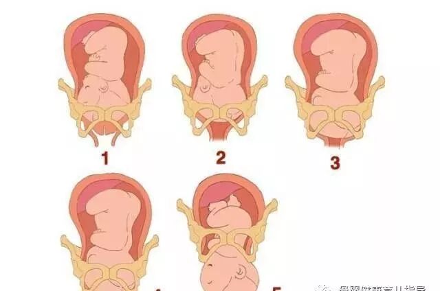 没做骨盆修复你后悔吗？我是后悔了！