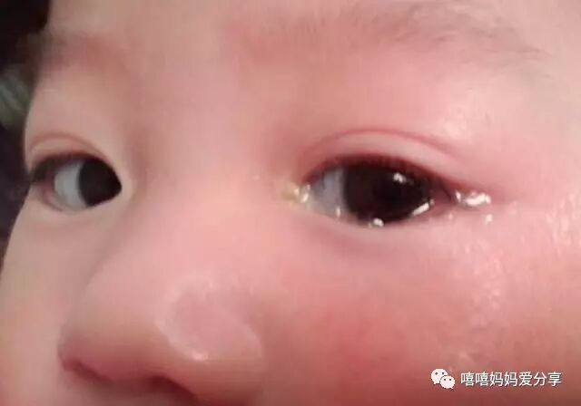 宝宝眼屎不断 还总是泪汪汪 这可能是鼻泪管不通 简书
