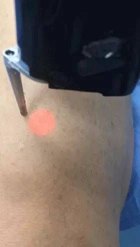 真狠！皮肤科男医生对自己的腿毛下手了！