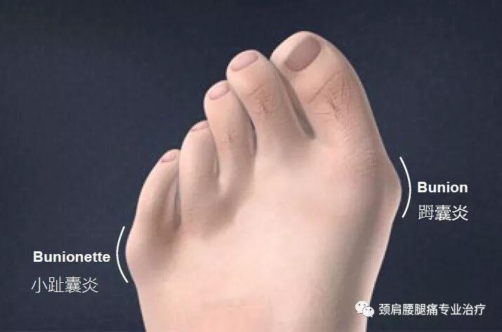 中英文字幕 小趾囊炎 裁缝趾 Bunionette Deformity Tailor S Bunion 自由微信 Freewechat