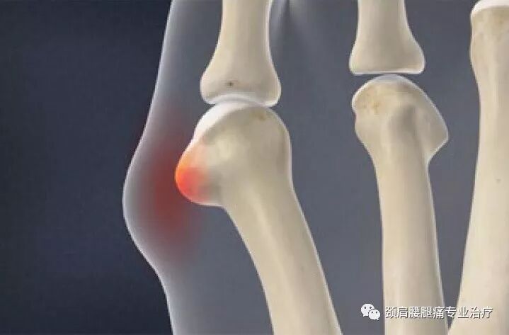 中英文字幕 小趾囊炎 裁缝趾 Bunionette Deformity Tailor S Bunion 自由微信 Freewechat