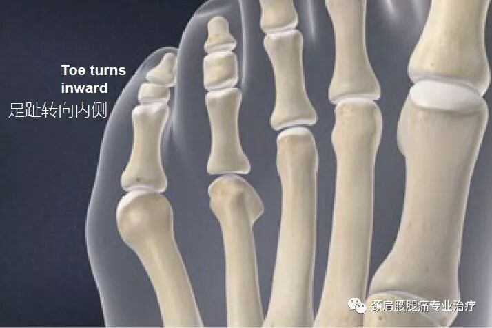 中英文字幕 小趾囊炎 裁缝趾 Bunionette Deformity Tailor S Bunion 自由微信 Freewechat