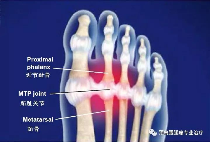 中英文字幕 跖趾关节滑膜炎 Mtp Synovitis 自由微信 Freewechat