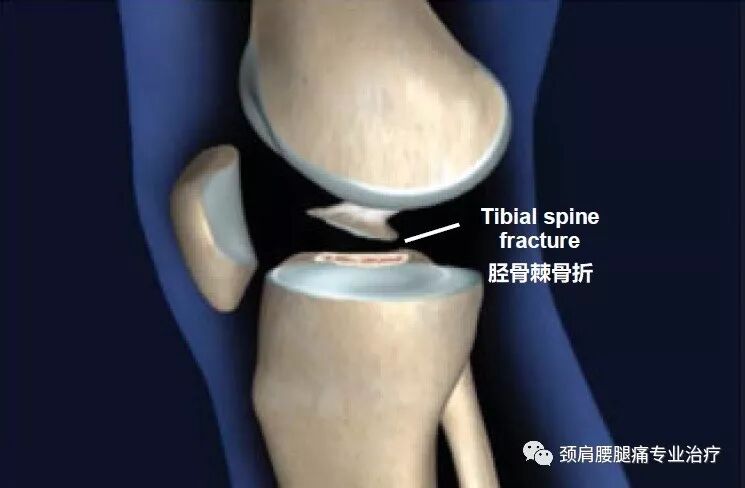 中英文字幕 胫骨棘骨折 Fractures Of The Tibial Spine 颈肩腰腿痛专业治疗 微信公众号文章阅读 Wemp