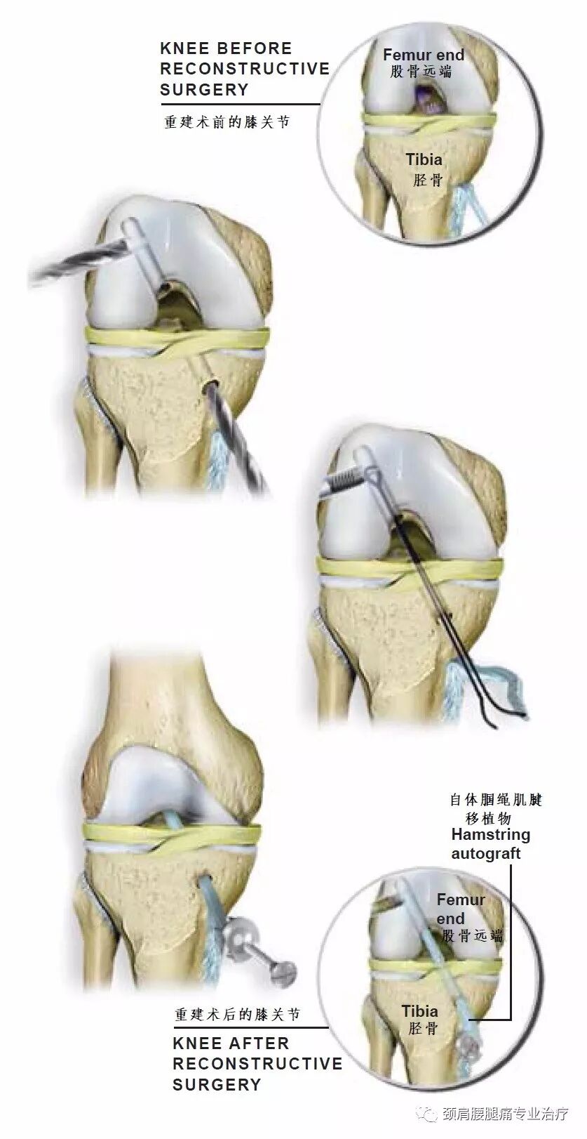 中英文字幕 使用腘绳肌腱重建前十字韧带 Acl Reconstruction With Hamstring 颈肩腰腿痛专业治疗 微信公众号文章阅读 Wemp