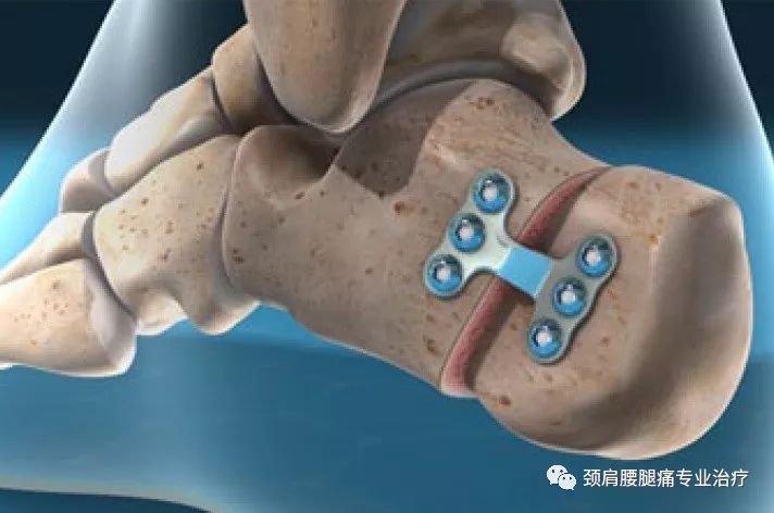 中英文字幕:跟骨滑行截骨术(calcaneal sliding osteo