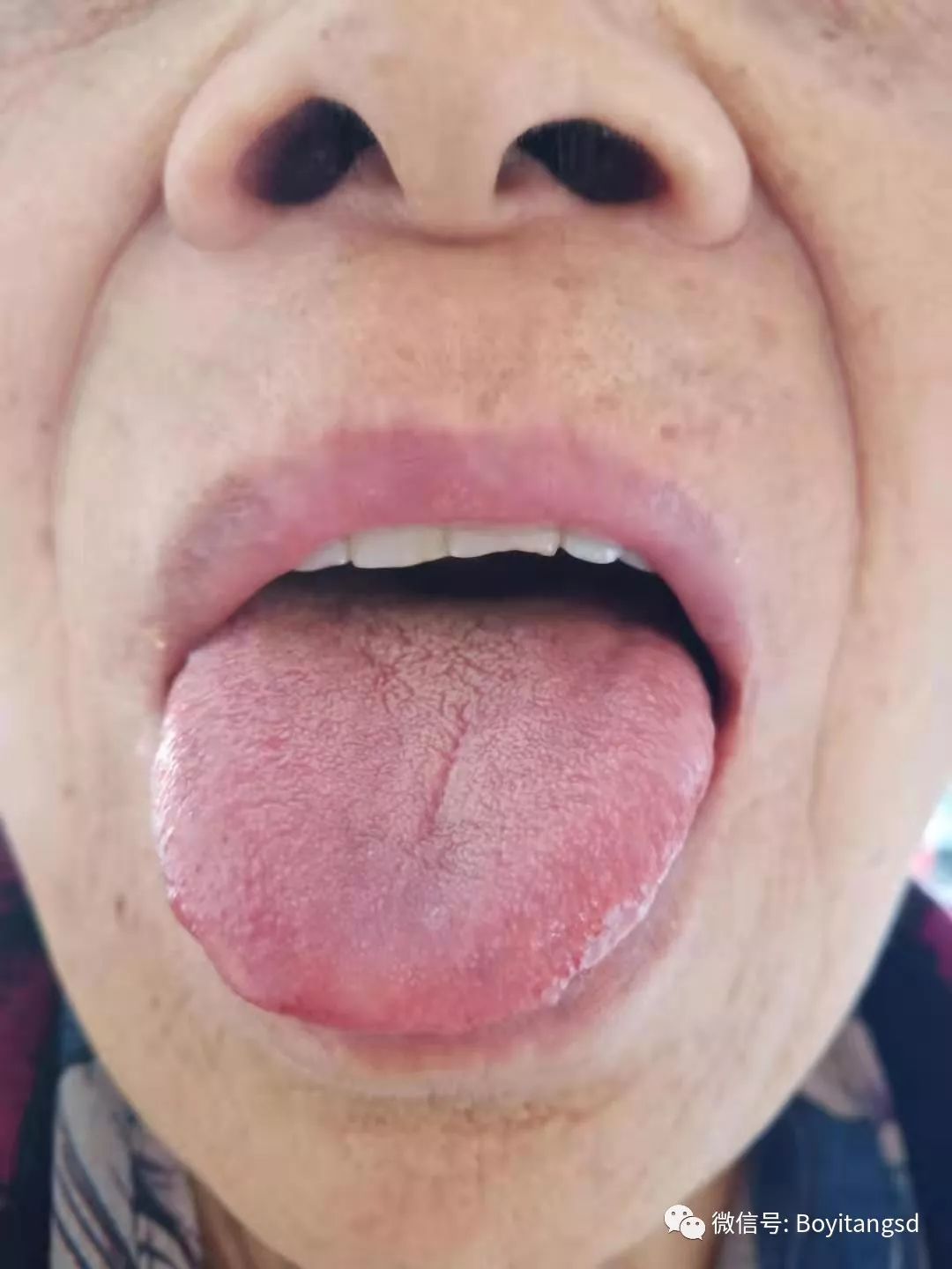 脑梗线明显,横竖都有,肩膀胀疼,颈椎腰椎都不好右图:舌诊:整体舌头歪 