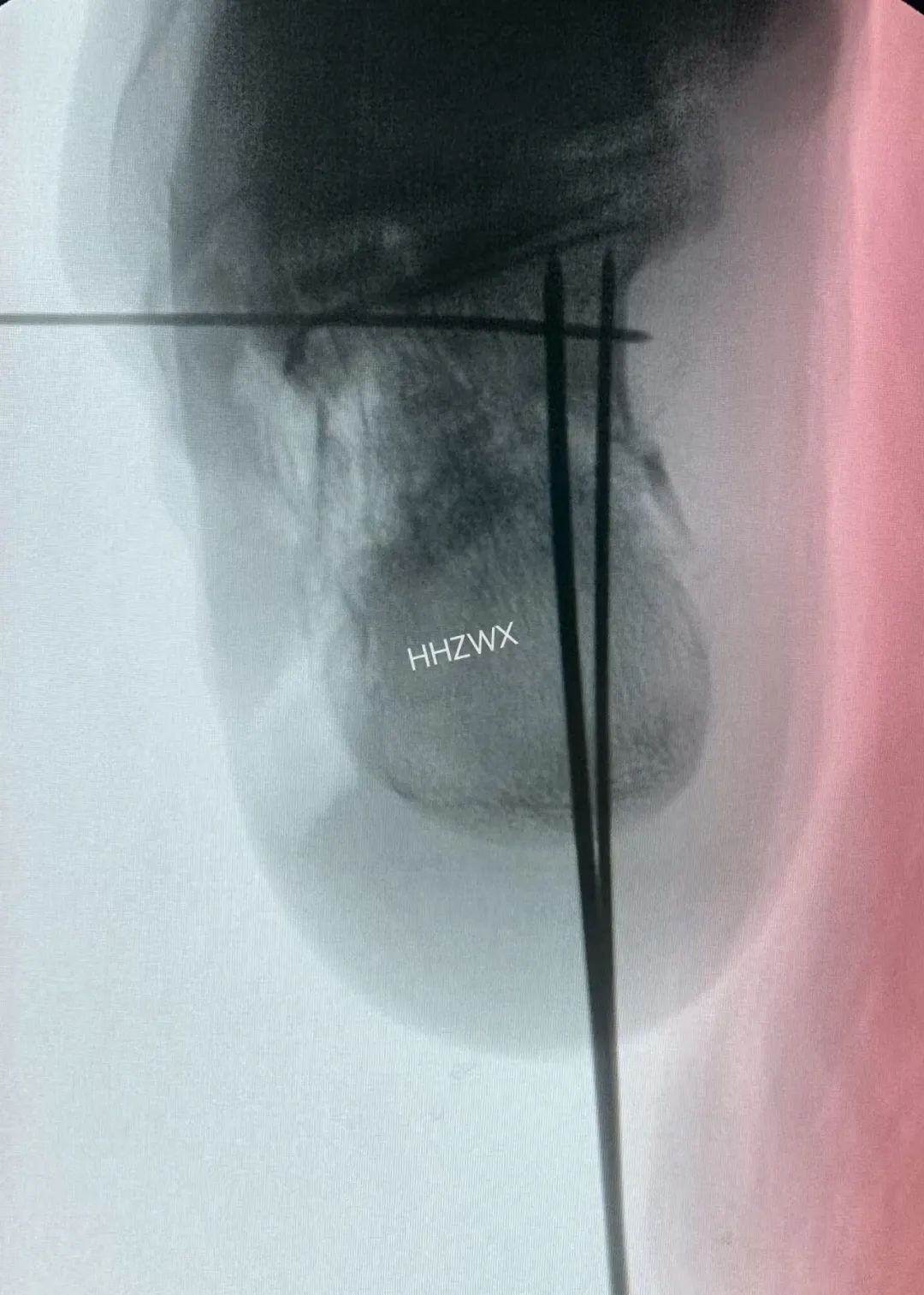 跟骨骨折如何轻松纠正内翻畸形，结合AO、坎贝尔、Rockwood、积水潭足踝外科经验总结及个人见解