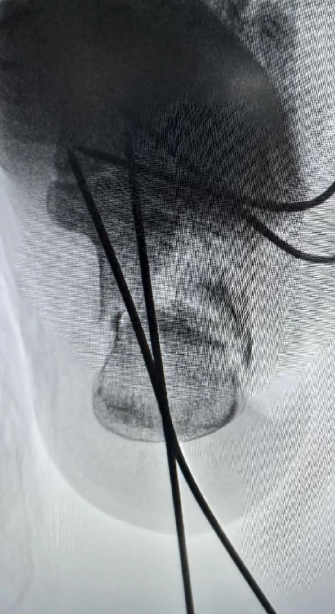 跟骨骨折如何轻松纠正内翻畸形，结合AO、坎贝尔、Rockwood、积水潭足踝外科经验总结及个人见解