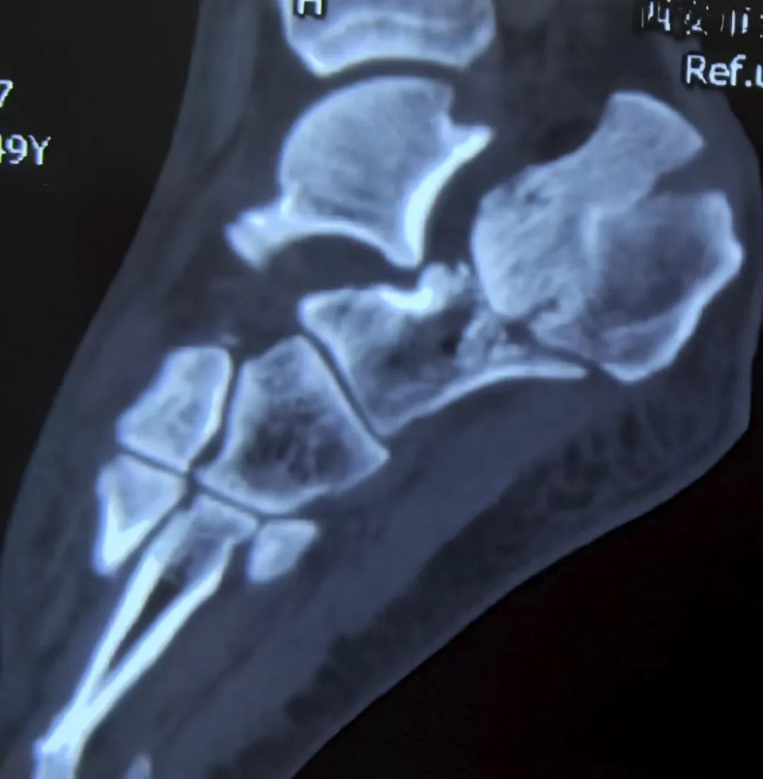 跟骨骨折如何轻松纠正内翻畸形，结合AO、坎贝尔、Rockwood、积水潭足踝外科经验总结及个人见解