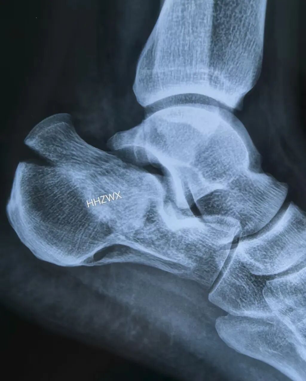 跟骨骨折如何轻松纠正内翻畸形，结合AO、坎贝尔、Rockwood、积水潭足踝外科经验总结及个人见解