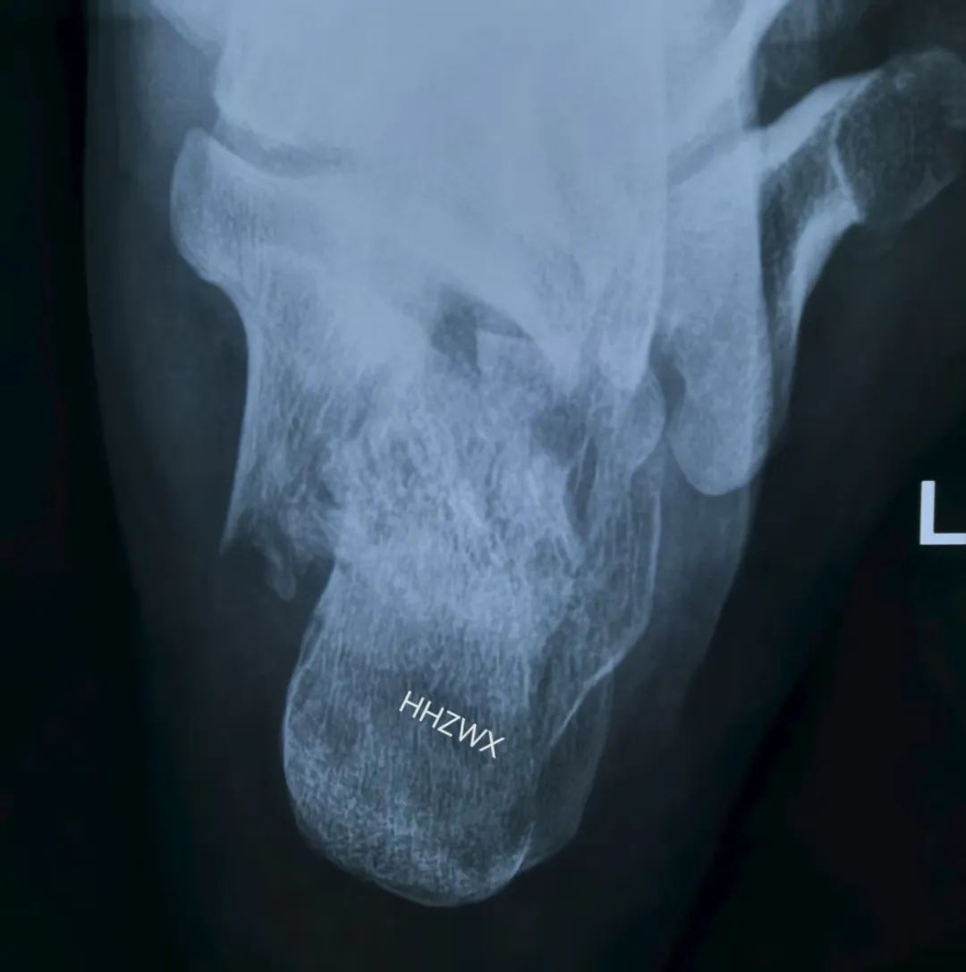 跟骨骨折如何轻松纠正内翻畸形，结合AO、坎贝尔、Rockwood、积水潭足踝外科经验总结及个人见解