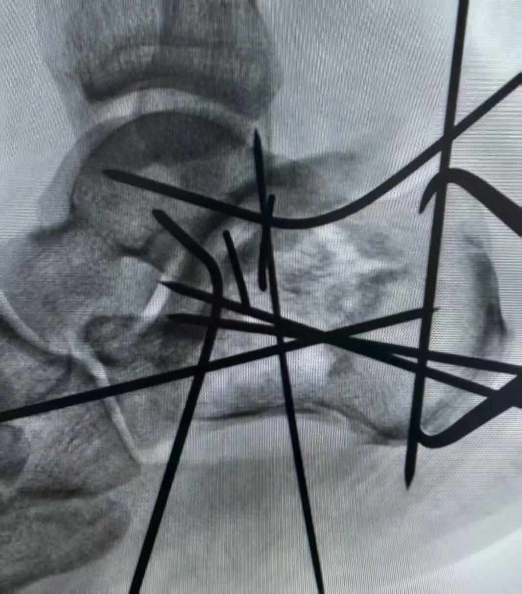 跟骨骨折如何轻松纠正内翻畸形，结合AO、坎贝尔、Rockwood、积水潭足踝外科经验总结及个人见解