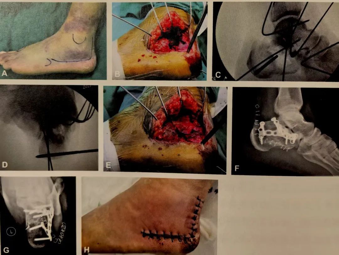 跟骨骨折如何轻松纠正内翻畸形，结合AO、坎贝尔、Rockwood、积水潭足踝外科经验总结及个人见解