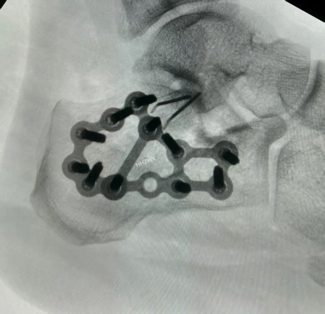 跟骨骨折如何轻松纠正内翻畸形，结合AO、坎贝尔、Rockwood、积水潭足踝外科经验总结及个人见解