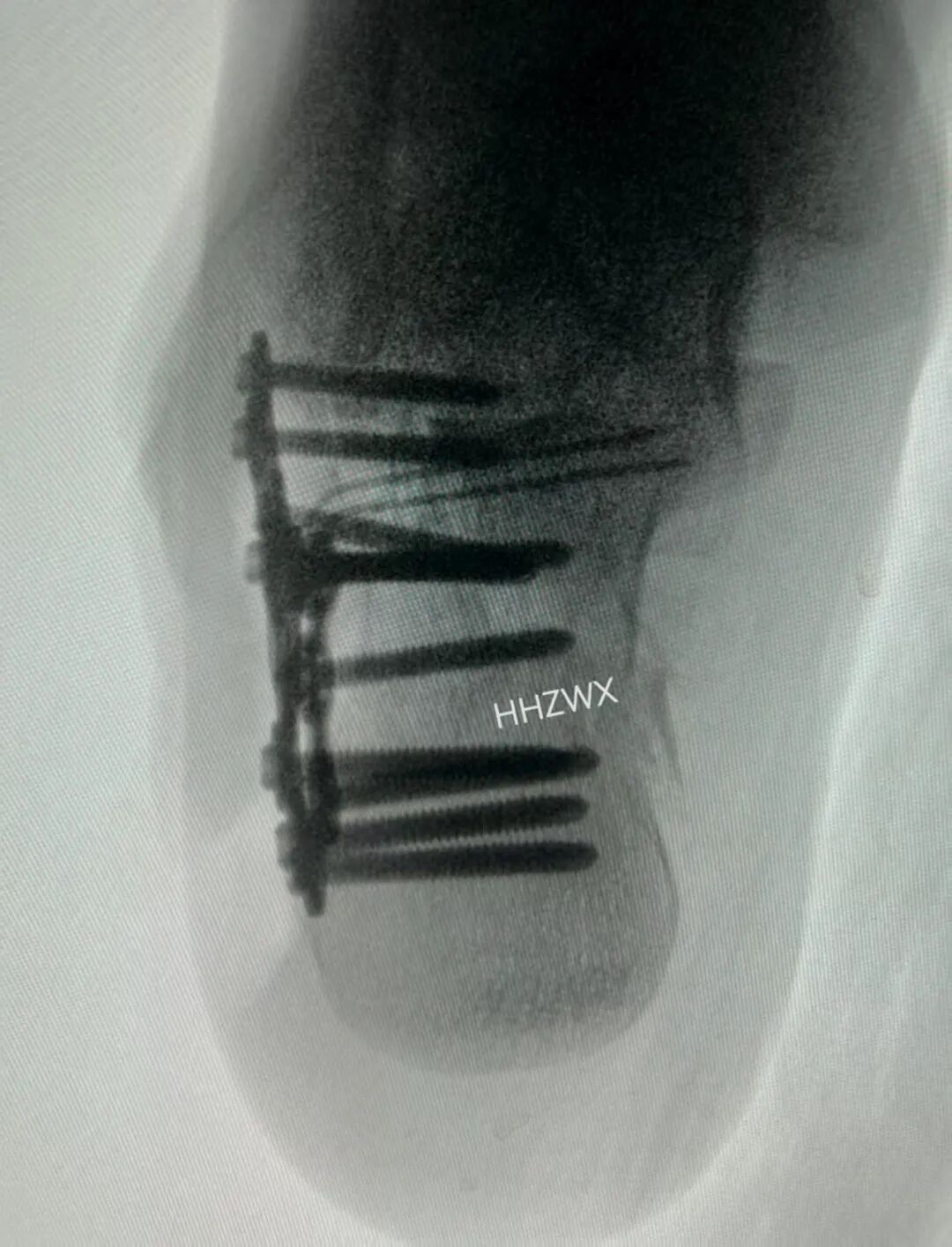 跟骨骨折如何轻松纠正内翻畸形，结合AO、坎贝尔、Rockwood、积水潭足踝外科经验总结及个人见解