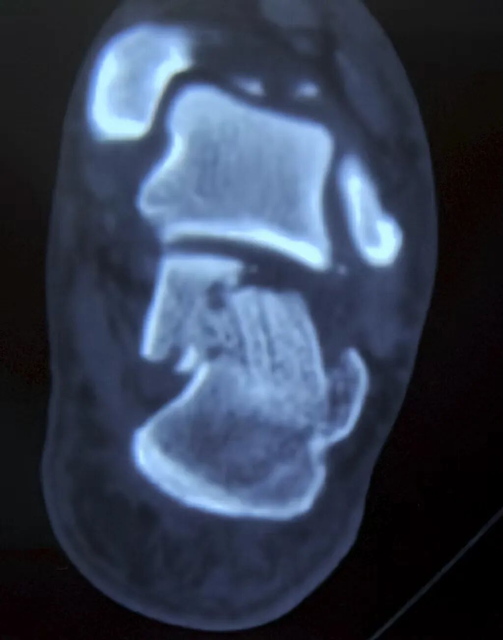 跟骨骨折如何轻松纠正内翻畸形，结合AO、坎贝尔、Rockwood、积水潭足踝外科经验总结及个人见解