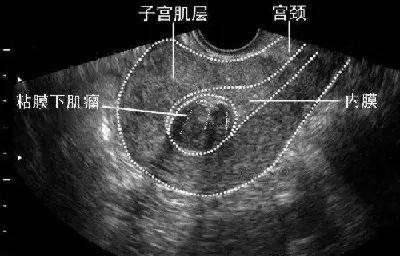 月經雜亂困擾多年，我為什麼最終選擇了子宮切除？ 健康 第4張