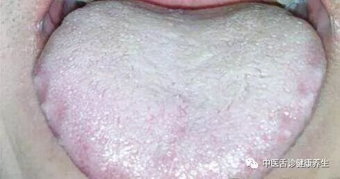 白苔可出现于体内有水湿停留或痰饮的病人,临床上常见某些胸水,腹水