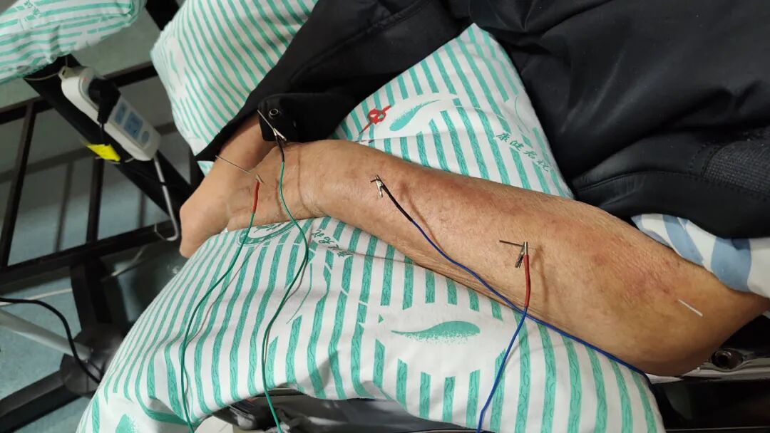 导什么针什么作用【医学科普】针灸——小小银针发挥大作用_https://www.jmylbn.com_新闻资讯_第10张