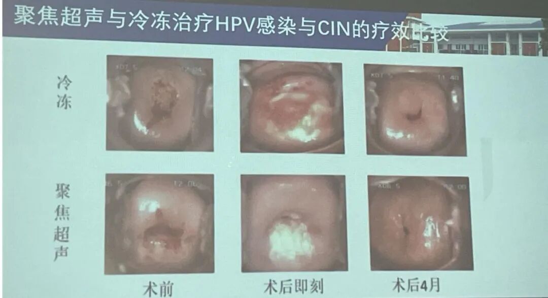 什么是超声波治疗仪​新项目新技术｜我院引进聚焦超声妇科治疗仪_https://www.jmylbn.com_新闻资讯_第4张