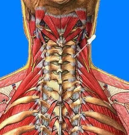 外展枕怎么使用总结的很全的针刀治疗要点，学针刀的人不容错过_https://www.jmylbn.com_新闻资讯_第5张